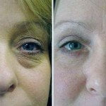 Eyelid-surgery-thailand-before-and-after