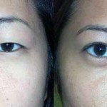 asia-eyelid-surgery-thailand