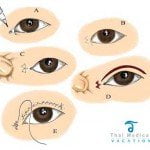 asian-eyelid-surgery-diagram