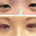 asian_eye_surgery_before_and_after-2