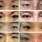 asian_eye_surgery_before_and_after-costs