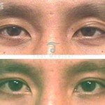 asian_eye_surgery_before_and_after-male