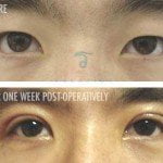 asian_eye_surgery_before_and_after-male2