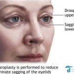 blepharoplasty-thailand