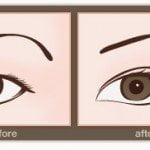 double-eyelids-asian-eyelid-surgery-before-after