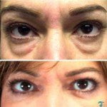 eyelid-surgery-thailand