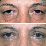 eyelid-surgery-thailand-before-after