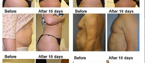 High Definition Smart Lipo in Thailand | Pictures | Reviews | Prices