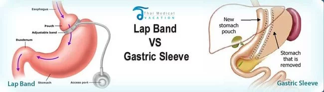 gastric-sleeve-thailand-vs-gastric-bypass-thailand-comparison