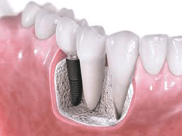 Dental-Implants-Thailand