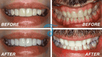 Teeth Whitening Thailand