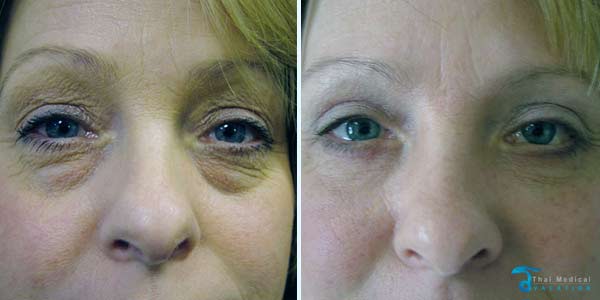 Eyelid-surgery-thailand-before-and-after
