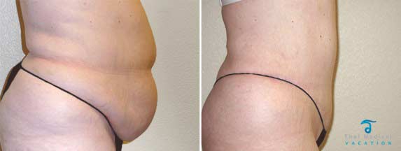 Tummy-Tuck-Thailand-Surgery-2