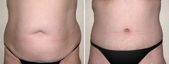 Tummy-Tuck-Thailand-Surgery