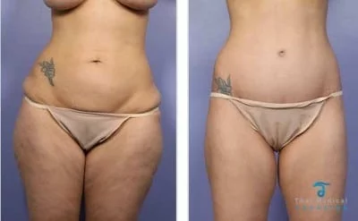 Tummy-Tuck-Thailand-before-and-after
