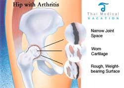 arthritis-hip-replacement-thailand