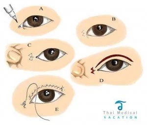 asian-eyelid-surgery-diagram-bangkok-thailand