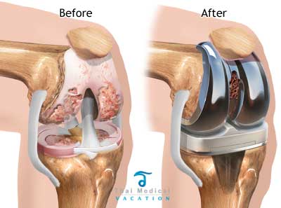 before-after-knee-replacement-in-thailand-pic