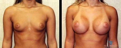 breast-augmentation-thailand