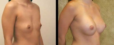 breast-augmentations-thailand-implants-bangkok