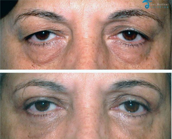 eyelid-surgery-thailand-before-after