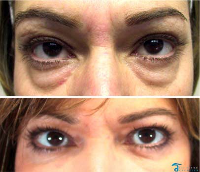 eyelid-surgery-thailand