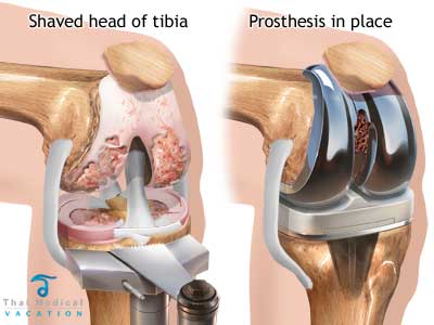 knee-replacement-alternatives-thailand-stem-cell-orthopedic
