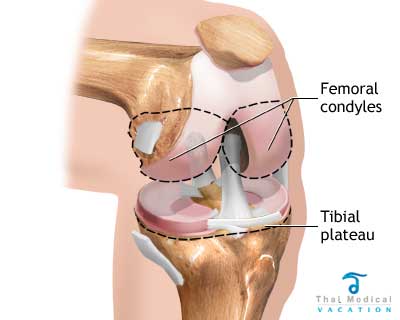 normal-knee-knee-replacement-in-Thailand