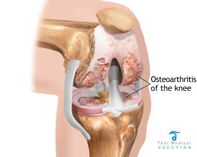 osteoarthritis-knee-replacement-in-thailand