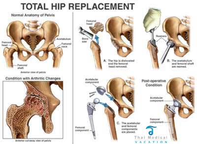 Fake Hips -  New Zealand