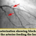 Cardiac-Catheterization-xray