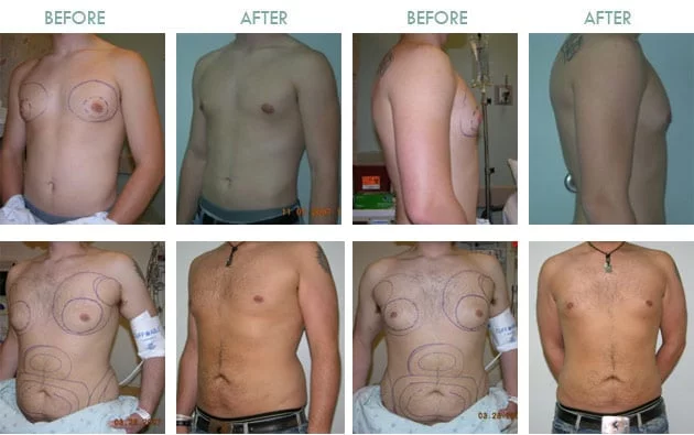 Male-Breast-Reduction-Thailand