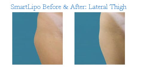 Smart-Lipo-thailand-Before-after-LatThigh