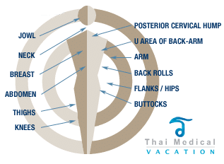 Vaser-Thailand-Liposuction-Areas