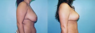 before-after-tummy-tuck-breast-reduction-thailand