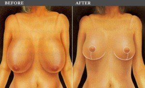 breast-reduction-bangkok