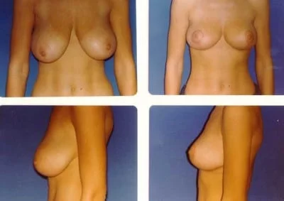 breast-reduction-in-thailand-plastic-surgery