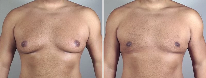 male-breast-reduction-in-thailand