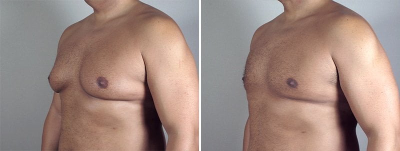 male-breast-reduction-thailand-2