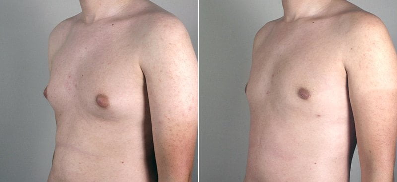 male-breast-reduction-thailand-3