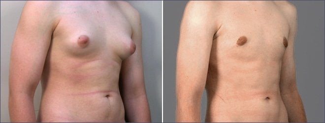 male-gynecomastia-bangkok