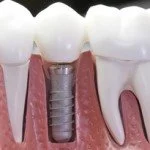 short-crown-implant-thailand