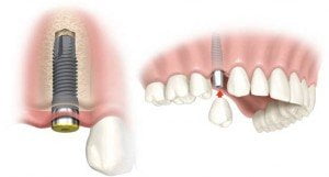 single-dental-implant-thailand