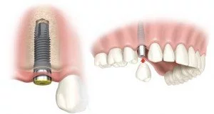 single-dental-implant-thailand