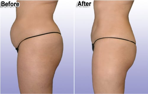 smart-lipo-thailand-before-and-after