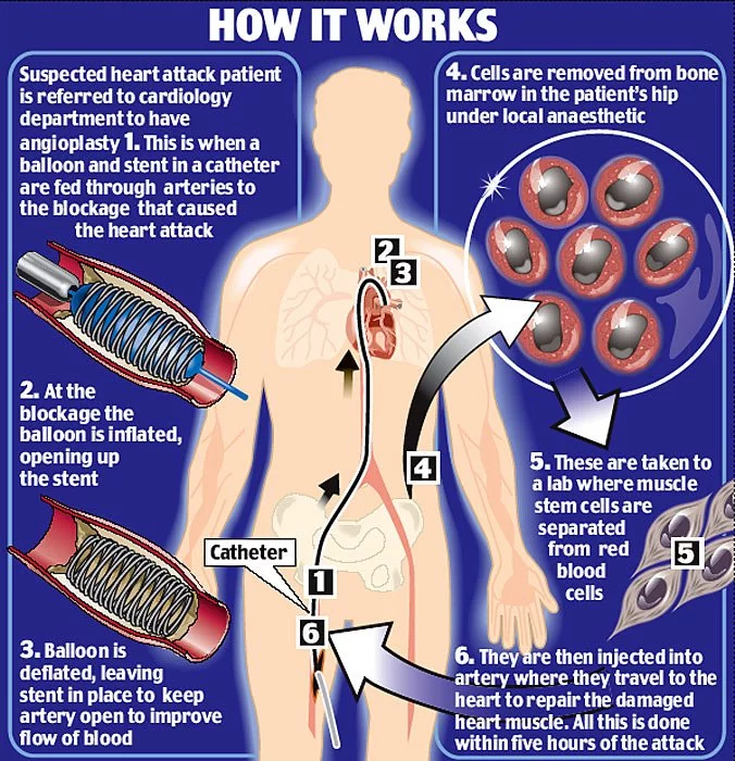 Stem Cell Therapy for Heart Disease Illustration