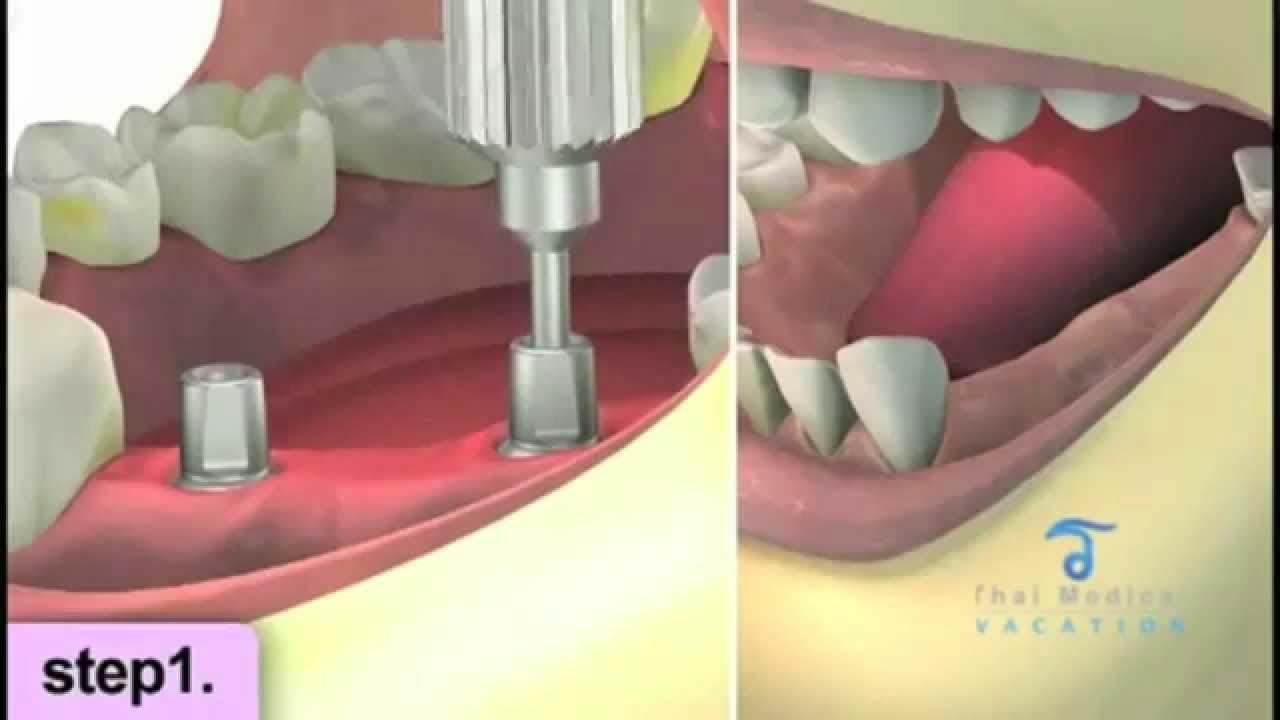 Immediate Load Dental Implants in Thailand