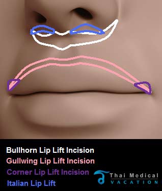 Lip-Lift-thailand-Incision-overview