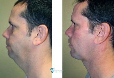 Neck-Lift-Thailand-Jimmy-before-after