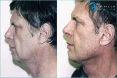 Neck-Lift-Thailand-Mike-before-after